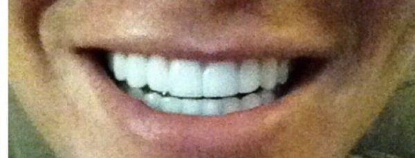 Pearly whites after my visit today with Dr.B