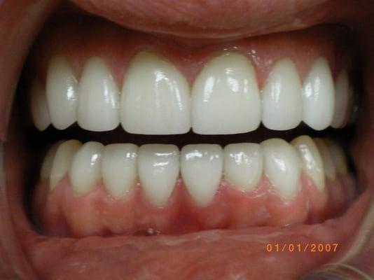 After 14 Veneers