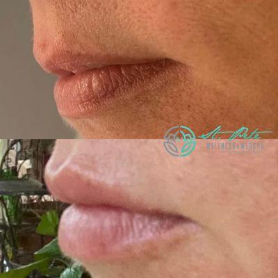 Lip - Versa fillers