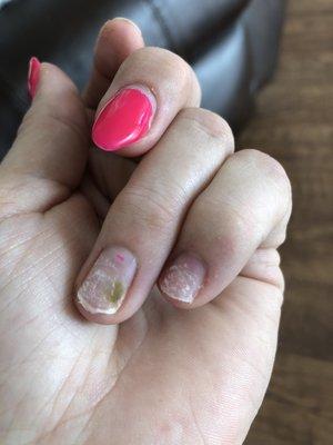 Nail fungus!!!