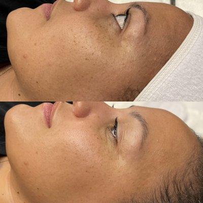 Before & After one facial treatment.