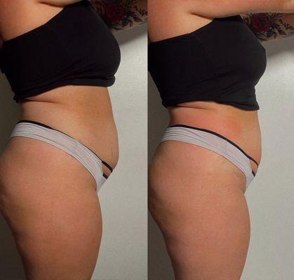 Slim 1/2 inch with first session! CryoSlimming