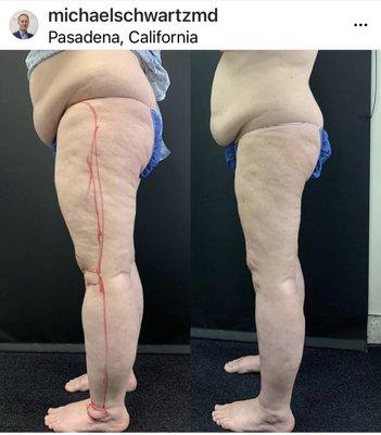 Lipedema: Vaser liposuction before and after