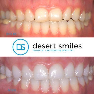 Radiant Smile Transformation! This was 4 new veneers and teeth whiting! Patient was so happy with the results!