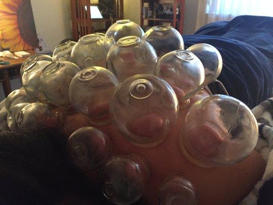 Cupping a Patient with Glass Fire-Cups