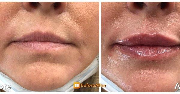 Montville MedSpa & Pain Center Fillers