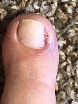 After Podiatrist had to cut out the nail all the way down!