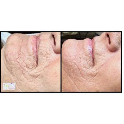 CA Skin Rejuvenation Protocol. PRX-T33