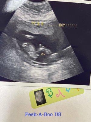 Peek- A- Boo ultrasound