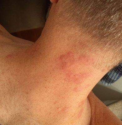 Bed bug bites back of neck after staying at ABV in Slidell LA near NOLA. They refused any compensation for our trouble.