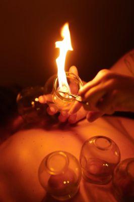 glass fire cups being applied to the skin with suction via negative pressure