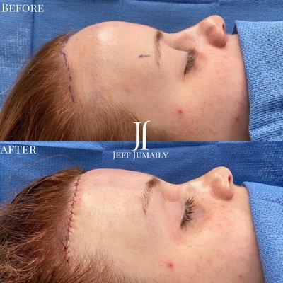 Forehead Reduction/ Hairline Lowering & Browlift