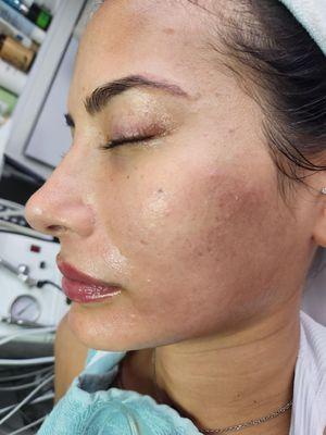 Micro-needling by Farrah before and after