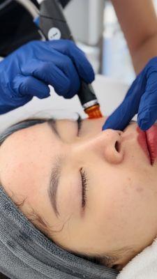 Medical-grade Hydrafacial