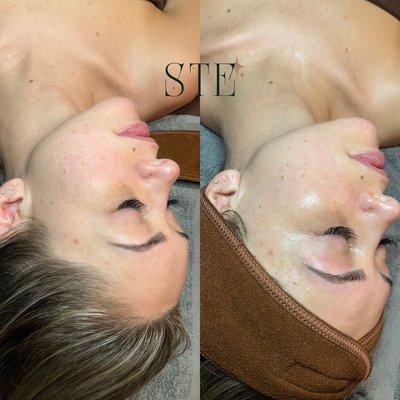 Before and after of an Ultra Glow Therapy Treatment