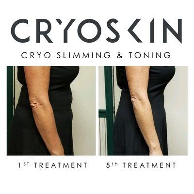 We guarantee you will lose at least 1/2 inch on your first CryoSkin Slimming session!