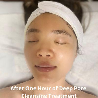 After One Hour of Deep Pore Cleansing Treatment