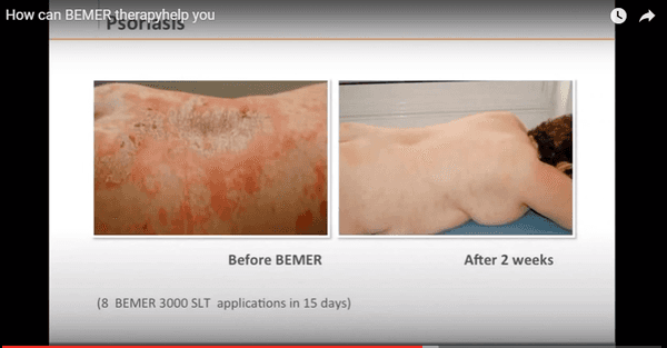 Psoriasis clearing up after 2 weeks using the Bemer.