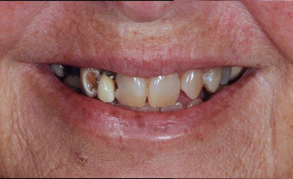 Initial smile with decayed and discolored teeth