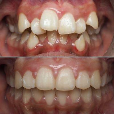 Before and after orthodontic alignment treatment.