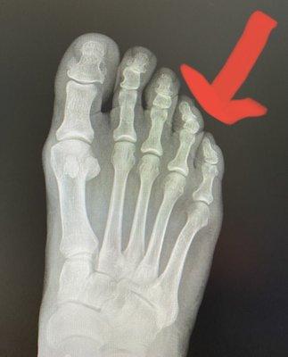 Prior to surgery Xray of hammer toe