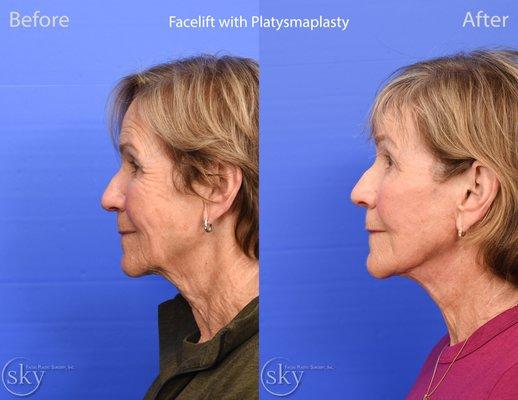 Facelift to correct lower facial laxity, jowling and neck banding. Natural results.