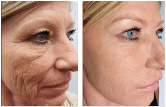 Our newest addition - Secret RF Microneedling Treatment