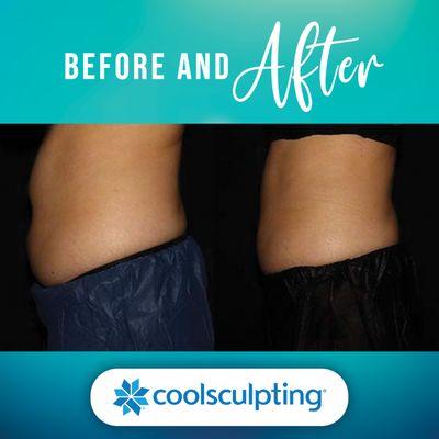 Coolsculpting Before and After at Bodenvy