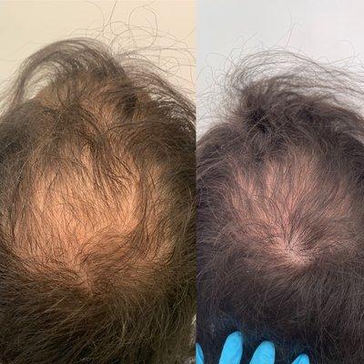 Before and after double PRP plus ACELL with topical medication in a 31 year male.