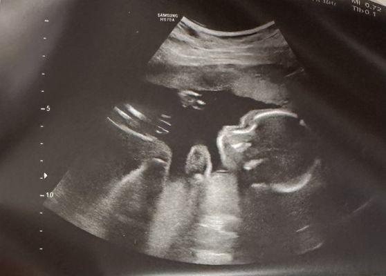 Our very first 2D baby profile ultrasound.