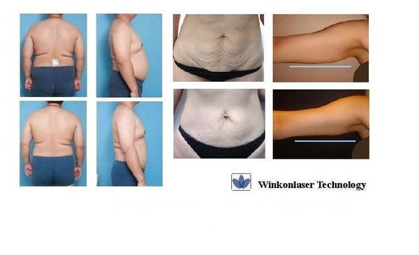 Ultrasound cavitation treatment, one inch same day ( fat and Cellulite) $500