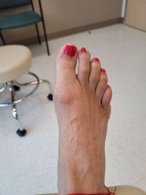 This is the before pic.   The ball is so painful!   I put a gardening tool through my foot.