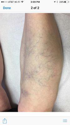 Before and after treatment for spider veins