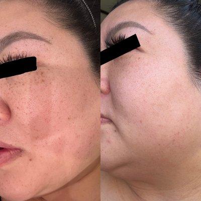 Hyperpigmentation Removal with  Cool View Laser after 1x Treatment (Left side of Face)