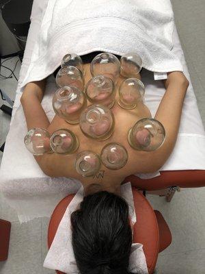 Cupping with Dr. Lu