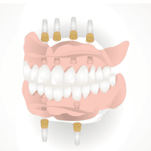 Full implant Package with 6 implants and 2 Custom Dentures