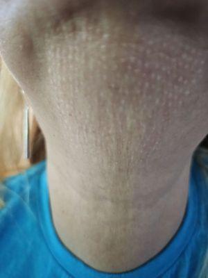 Scars after a double chin trial. We have spent thousands trying to correct this scarring from her procedure.