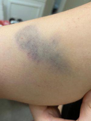 Arm with bruise