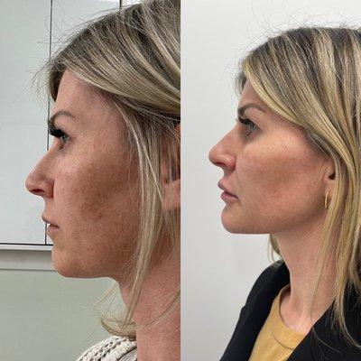 Chin, cheek and jawline filler