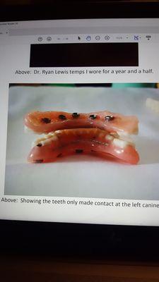 Harogiannis last temps, no back teeth contact.