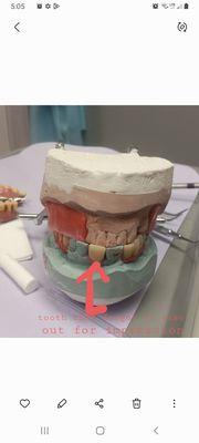 My partials green clay is my real teeth they forgot one....cause they never took out the tooth for impression....duh