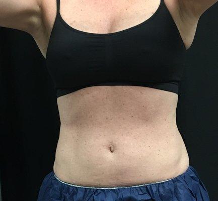 CoolSculpting Abdomen and flanks  4 months AFTER