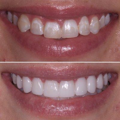 Before and After 10 Porcelain Veneers.