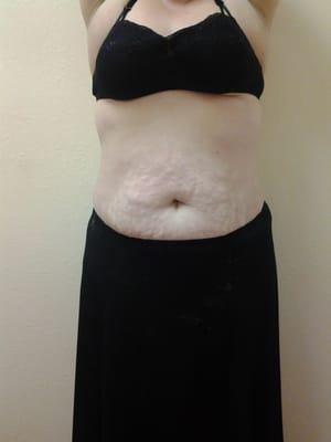 After 6 cavi-lipo treatments