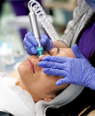 Hydrodermabrasion Facial