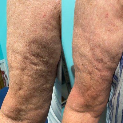 Cellulite in the arms after one session