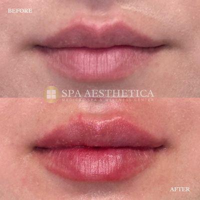 Lip Filler Before and Immediately After. Non-Surgical Lip Augmentation