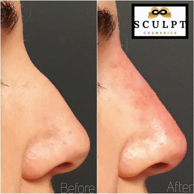 Non surgical Nose job