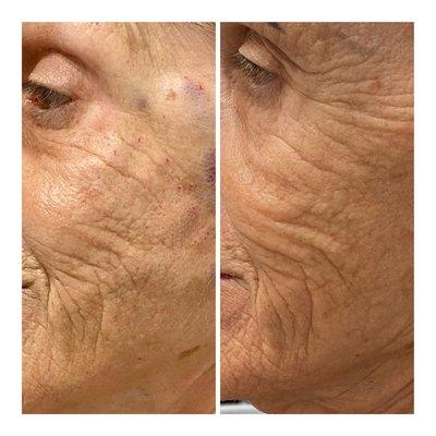 Wrinkle reduction