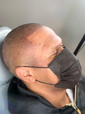 Scalp Micropigmentation at Scalp Prodigy.